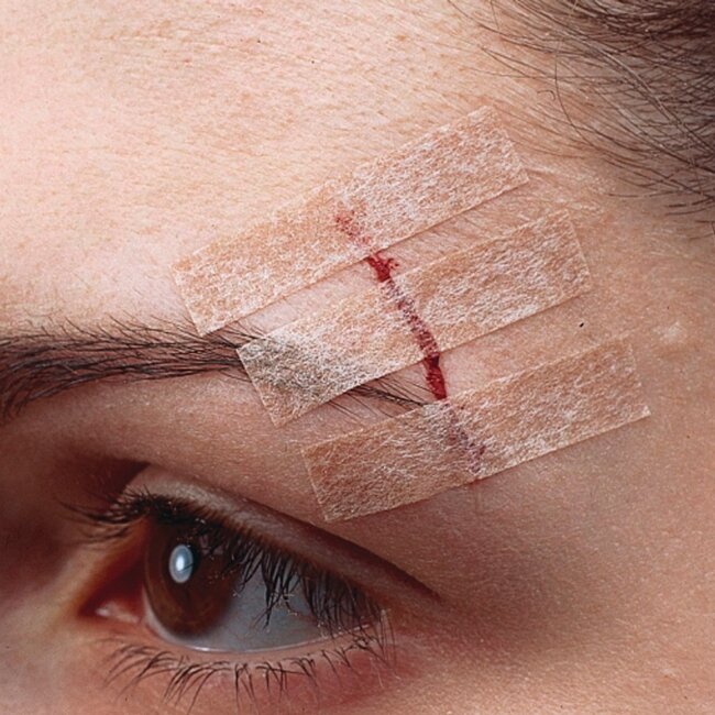 Лейкопластыри Nexcare™ Steri-Strip™ для закрытия ран, телесного цвета, 6 мм х 75 мм, 6 шт в упаковке Лейкопластыри Nexcare™ Steri-Strip™ для закрытия ран, телесного цвета, 6 мм х 75 мм, 6 шт в упаковке