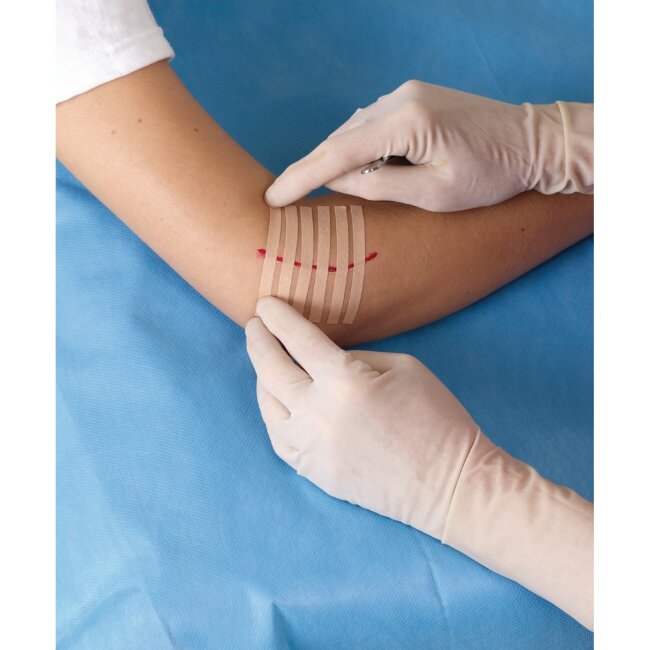 Лейкопластыри Nexcare™ Steri-Strip™ для закрытия ран, телесного цвета, 6 мм х 75 мм, 6 шт в упаковке Лейкопластыри Nexcare™ Steri-Strip™ для закрытия ран, телесного цвета, 6 мм х 75 мм, 6 шт в упаковке